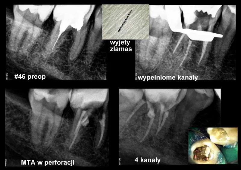 Wyjęcie złamanego narzędzia i zamknięcie perforacji cementem MTA